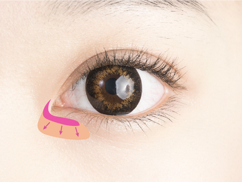隱痕開眼頭手術-撥離眼頭區域的皮膚